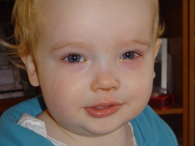 Andrew with Conjunctivitis